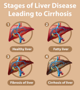 Liver Disease